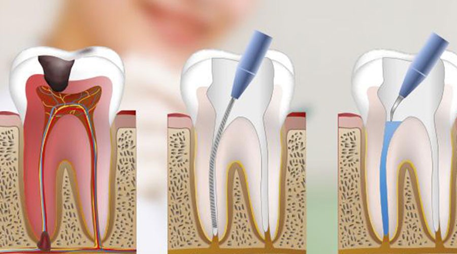 Tratamiento de Endodoncia en guayaquil